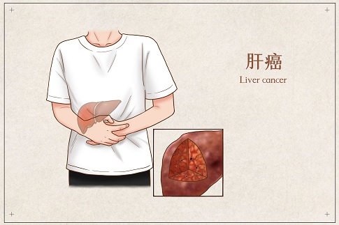 1653321154268908.jpg 攝圖網(wǎng)_401794893_banner_肝癌醫(yī)療插畫(企業(yè)商用).jpg
