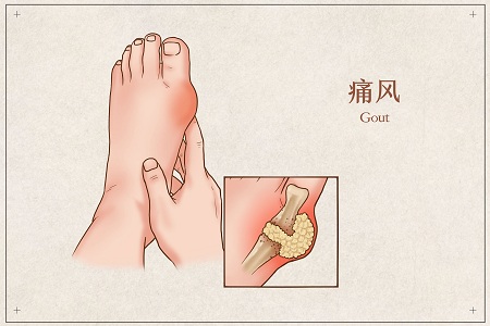1653843131531128.jpg 攝圖網_401794683_banner_痛風醫療插畫(企業商用).jpg