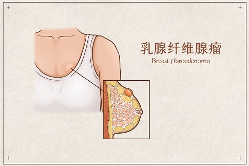 1659196941381671.jpg 攝圖網(wǎng)_401789492_banner_乳腺纖維腺瘤醫(yī)療插畫示意圖(企業(yè)商用).jpg
