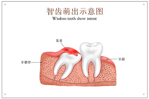 1659282417578019.jpg 攝圖網(wǎng)_401803631_智齒萌出示意圖(企業(yè)商用).jpg