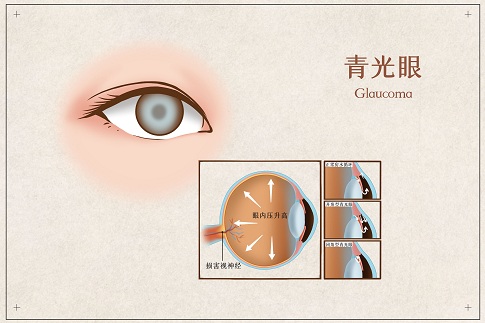 1659973542831971.jpg 攝圖網_401804072_青光眼醫療插畫(企業商用).jpg
