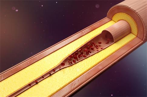 1665093376603274.jpg 攝圖網(wǎng)_402137714_banner_血管狹窄粥樣硬化場(chǎng)景(企業(yè)商用).jpg