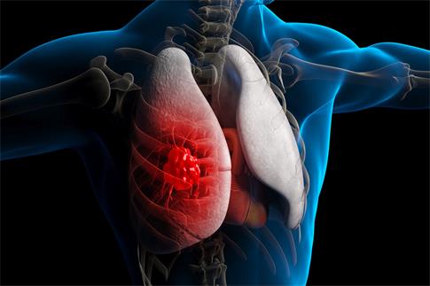 1671841864923621.jpg 攝圖網(wǎng)_401907175_banner_肺病肺癌3D疾病場景(非企業(yè)商用).jpg