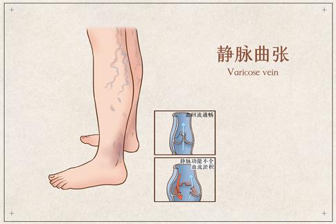 1701387452406509.jpg 攝圖網(wǎng)_401799108_靜脈曲張醫(yī)療插畫(企業(yè)商用).jpg