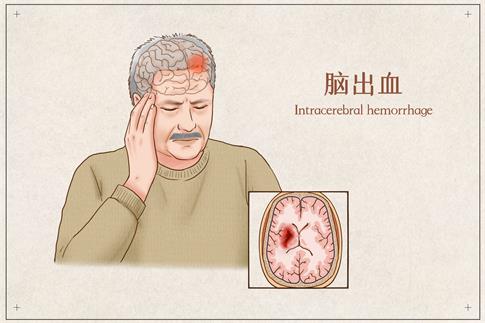 1705325479716489.jpg 攝圖網_401795919_腦出血醫療插畫(企業商用).jpg