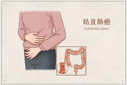 1707178438614265.jpg 攝圖網_401799663_結直腸癌醫療插畫(企業商用).jpg