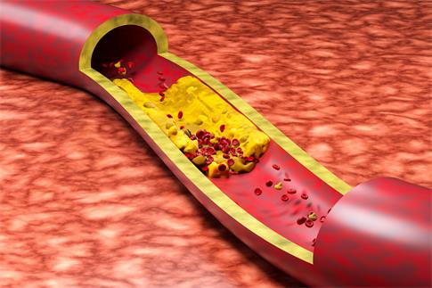 1711440439228803.jpg 攝圖網(wǎng)_402018369_banner_血管堵塞(企業(yè)商用).jpg