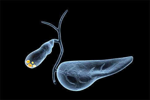 1717803731675634.jpg 攝圖網_401863060_膽囊結石(企業商用).jpg