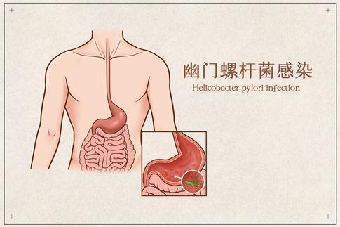 1750507413460226.jpg 攝圖網_401789751_banner_幽門螺桿菌感染醫療插畫(企業商用).jpg