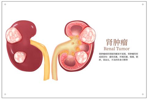 1751513635268596.jpg 攝圖網_402717159_banner_器官腎腫瘤解剖圖醫學分析插畫(企業商用).jpg